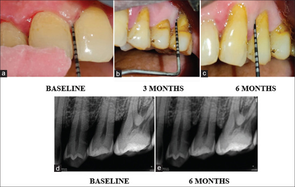 Comparative evaluation of herbal gel as an adjunct to nonsurgical periodontal therapy in Stage III periodontitis: A randomized split-mouth clinical trial.