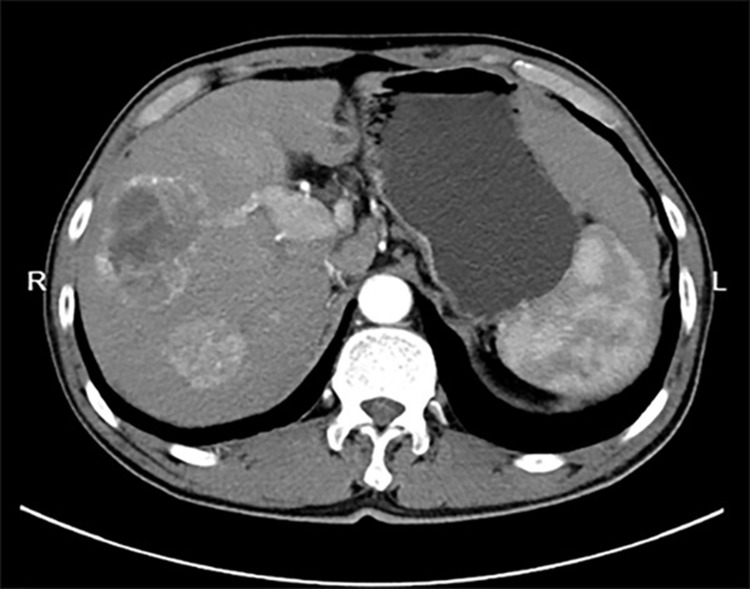 Thyroid Gland as a Metastatic Site for Hepatocellular Carcinoma: A Rare Case Report.