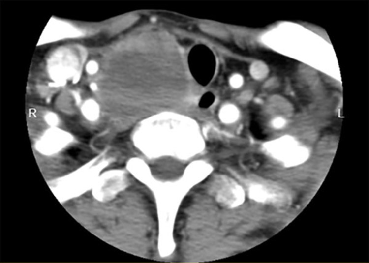 Thyroid Gland as a Metastatic Site for Hepatocellular Carcinoma: A Rare Case Report.