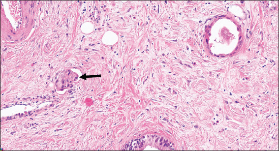 The usefulness of B-cell lymphoma-2 immunohistochemical stain in the differentiation between reactive atypia and dysplasia/carcinoma in the gallbladder.