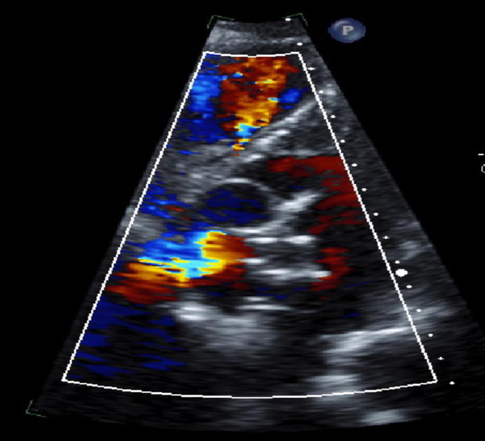 Unmasking the Rarity: A Case Report on Platypnea-Orthodeoxia Syndrome With Successful Resolution Through Patent Foramen Ovale Closure.