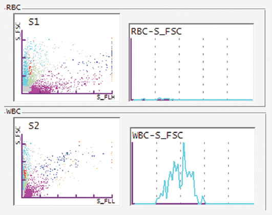Comparison of two automated urine cytometry systems: Sysmex<sup>®</sup> UF-1000i and Beckman Coulter<sup>®</sup> DxU 850 Iris.