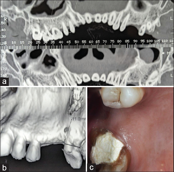 Ultrawide implants for immediate molar extraction socket versus standard diameter fixtures in healed alveolar ridges of missing molars, one-year postloading evaluation: A randomized controlled trial.