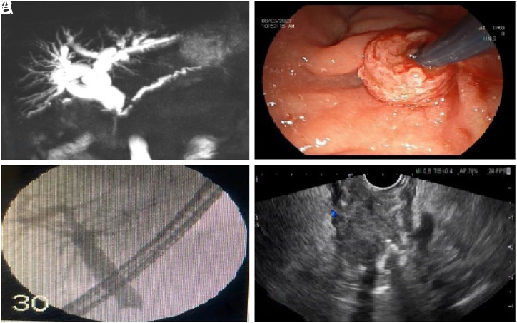A Rare Cause of Mechanical Icterus: Prostate Cancer Metastasis.