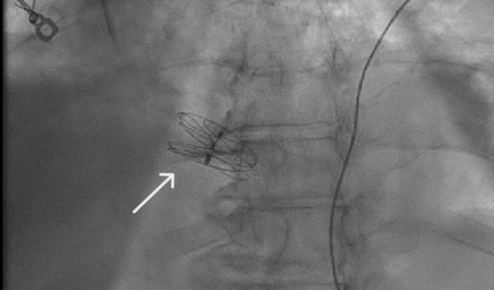 Unmasking the Rarity: A Case Report on Platypnea-Orthodeoxia Syndrome With Successful Resolution Through Patent Foramen Ovale Closure.