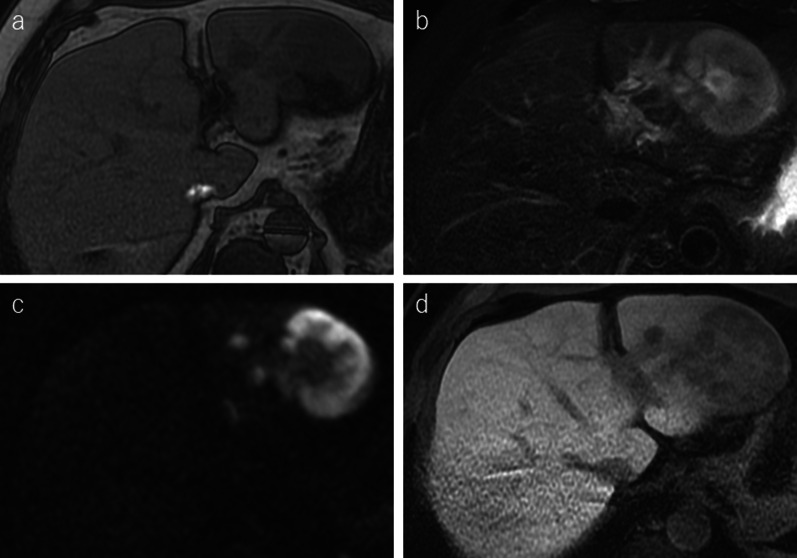 Hepatic methotrexate-associated lymphoproliferative disease: a case report and literature review.