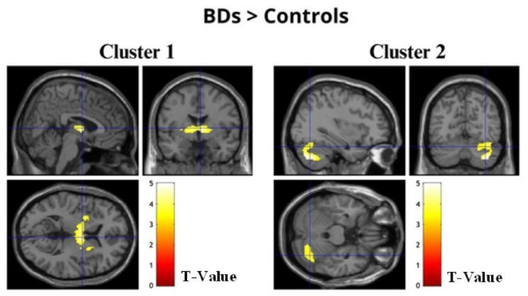 Associative memory in alcohol-related contexts: An fMRI study with young binge drinkers.