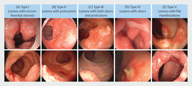 Endoscopic features of rectal mucosal prolapse syndrome (RMPS): Differentiation from malignant rectal tumor.