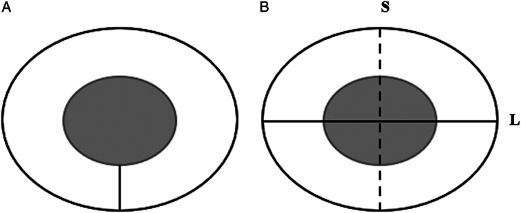 The Value of Magnetic Resonance Imaging in Assessing Immediate Efficacy After Microwave Ablation of Lung Malignancies.
