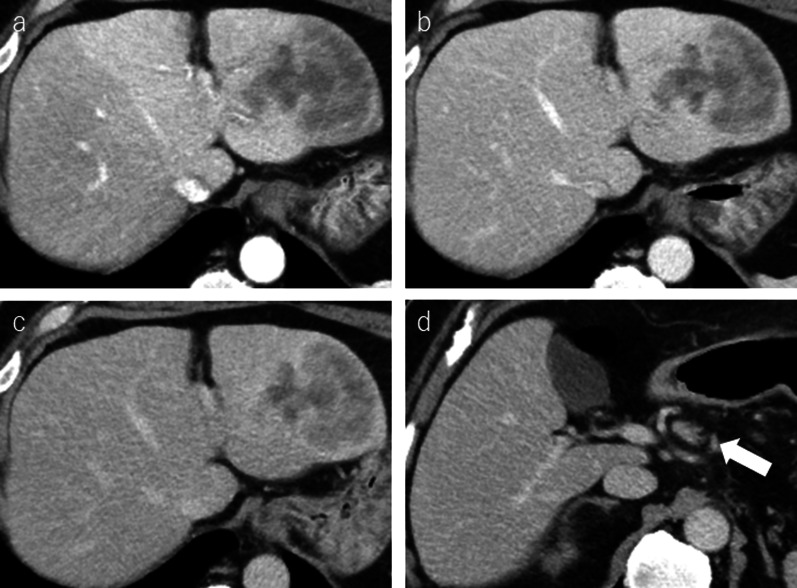 Hepatic methotrexate-associated lymphoproliferative disease: a case report and literature review.