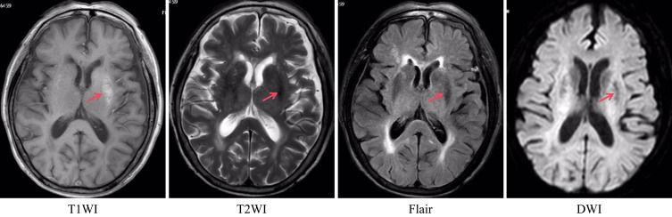 Chorea in Hemodialysis Patients: Report of Two Cases.