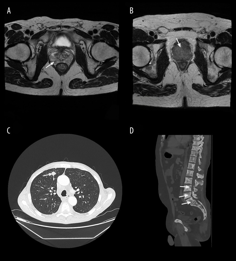 Correlation of Cytokine Profiles with Prostate-Specific Antigen and Disease Grade in Prostate Cancer.