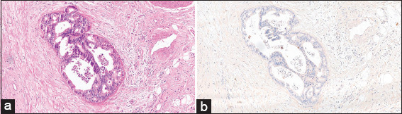 The usefulness of B-cell lymphoma-2 immunohistochemical stain in the differentiation between reactive atypia and dysplasia/carcinoma in the gallbladder.
