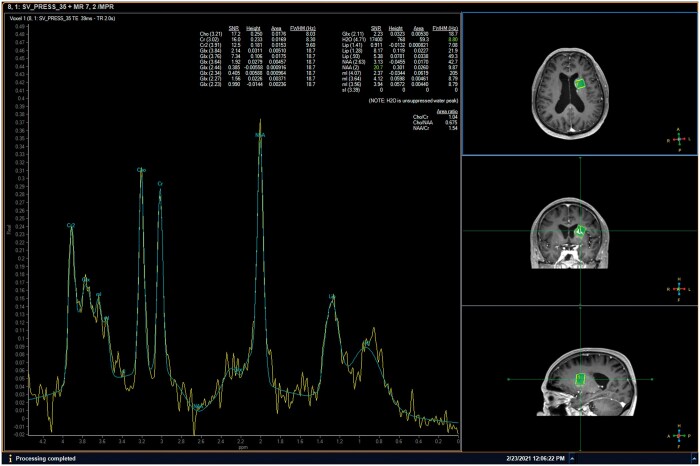 Non-ketotic hyperglycaemia-induced hemichorea-hemiballism may represent glioma-like pattern on multimodal magnetic resonance imaging: can <sup>1</sup>H spectroscopy help in the differentiation?
