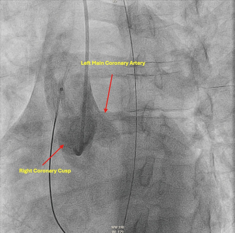 Electrical storm caused by sertraline overdose: case report.