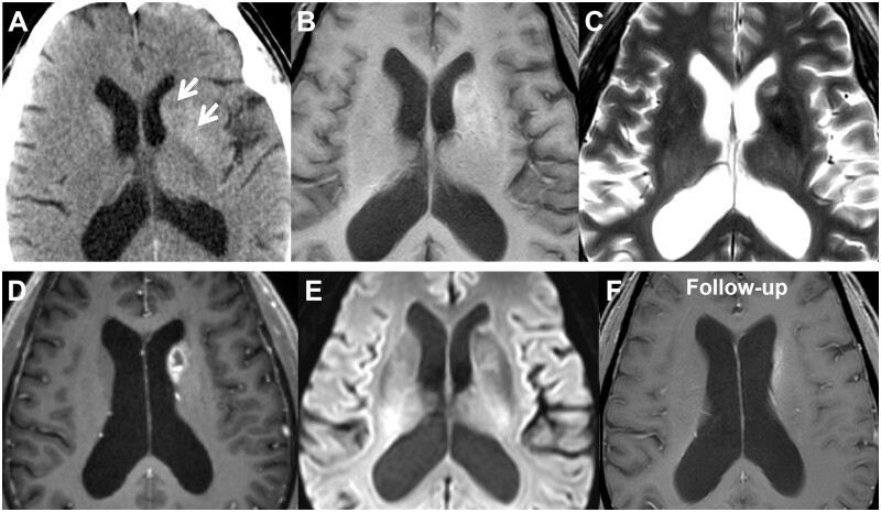 Non-ketotic hyperglycaemia-induced hemichorea-hemiballism may represent glioma-like pattern on multimodal magnetic resonance imaging: can <sup>1</sup>H spectroscopy help in the differentiation?