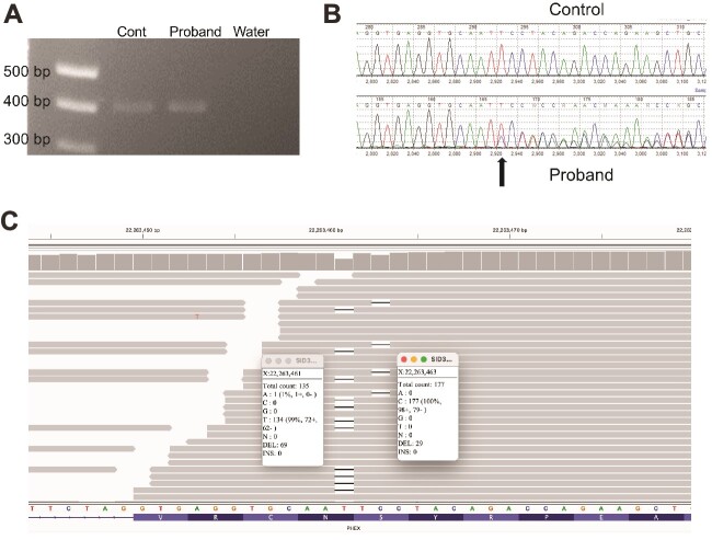 Unusual <i>PHEX</i> variants implicate uncommon genetic mechanisms for X-linked hypophosphatemic rickets.
