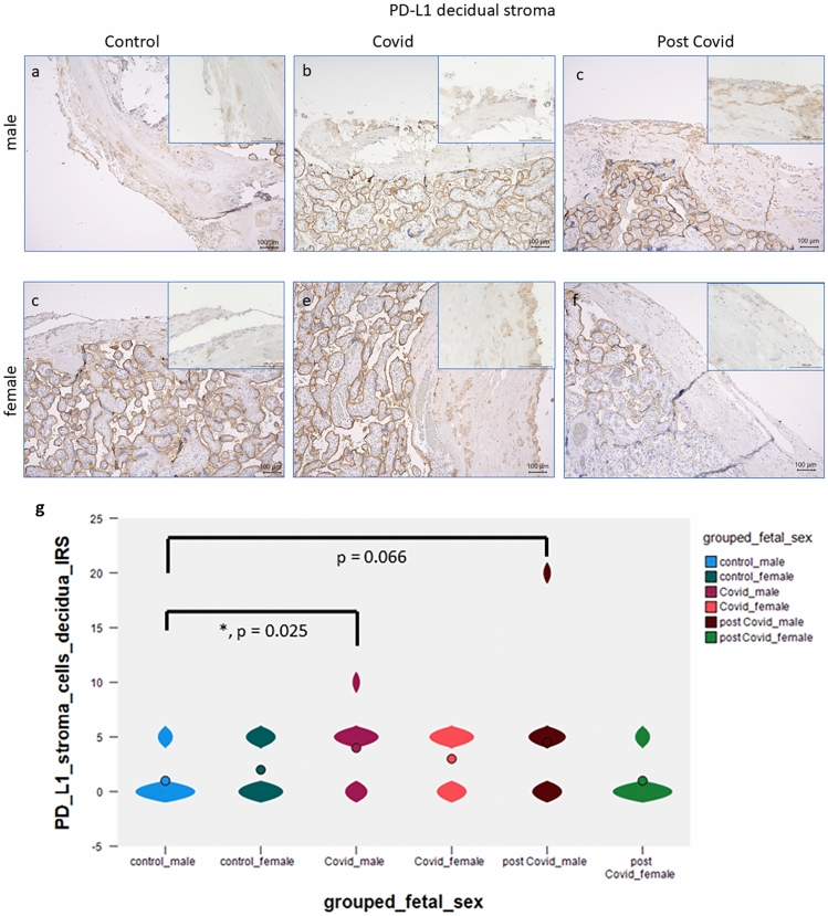 PD-L1 expression and characterization of its carrier macrophages in placentas with acute and specifically post-SARS-CoV-2 infection.