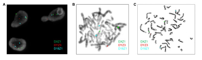 False-positive XXY results by interphase FISH in cytogenetically normal XX individuals: two cases highlighting the necessity of additional laboratory follow-up.