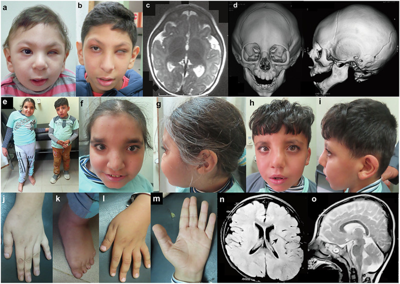Biallelic loss-of-function variants in GON4L cause microcephaly and brain structure abnormalities.