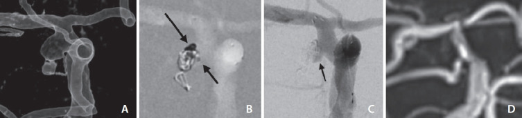 Technical Approaches for Coil Embolization of Unruptured Small Anterior Choroidal Artery Aneurysms: A Focus on Anatomical Flow Preservation of the Anterior Choroidal Artery.