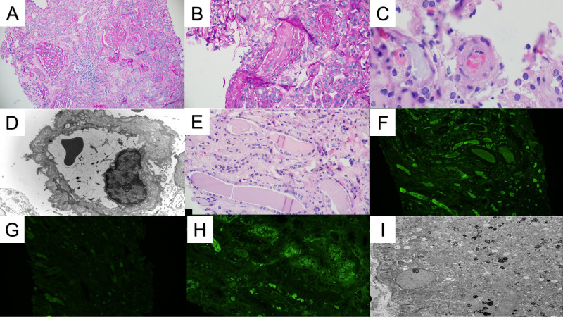 Triple monoclonal protein-related kidney lesions in a patient with plasma cell dyscrasia: a case report.