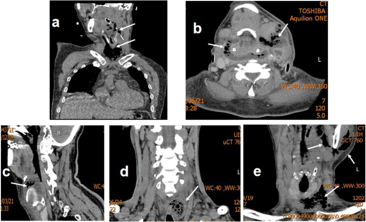 Clinical Features of Severe Deep Neck Space Infection: Five Clinical Cases and Our Experience in Their Management.