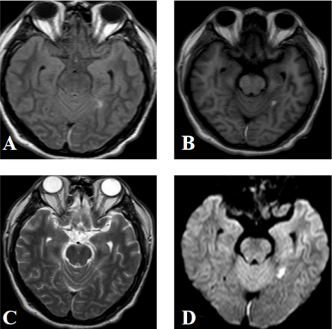 Autoimmune encephalitis with coexisting antibodies to GABABR, GAD65, SOX1 and Ma2.