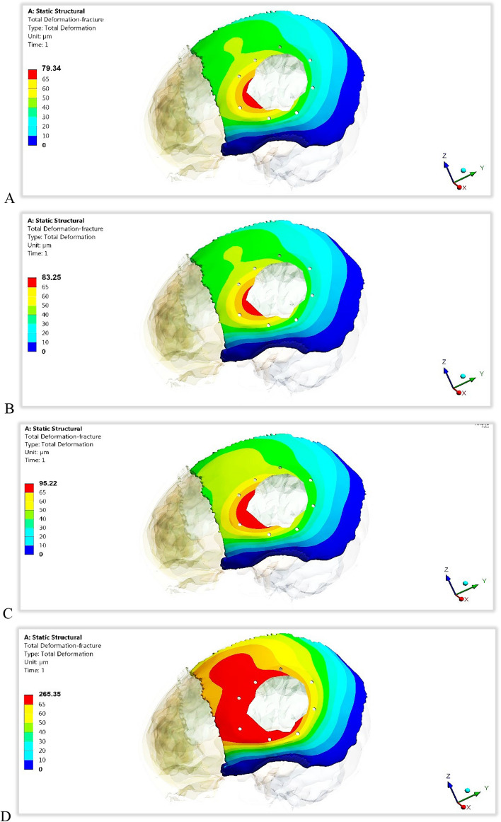 Cranial reconstruction utilizing polymeric implants in two different designs: finite element investigation.