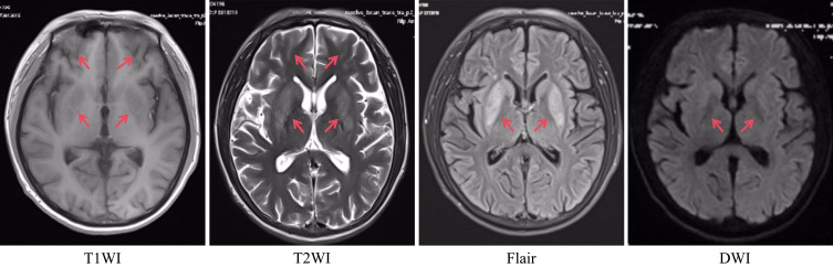 Chorea in Hemodialysis Patients: Report of Two Cases.