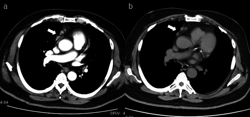 Hepatic methotrexate-associated lymphoproliferative disease: a case report and literature review.
