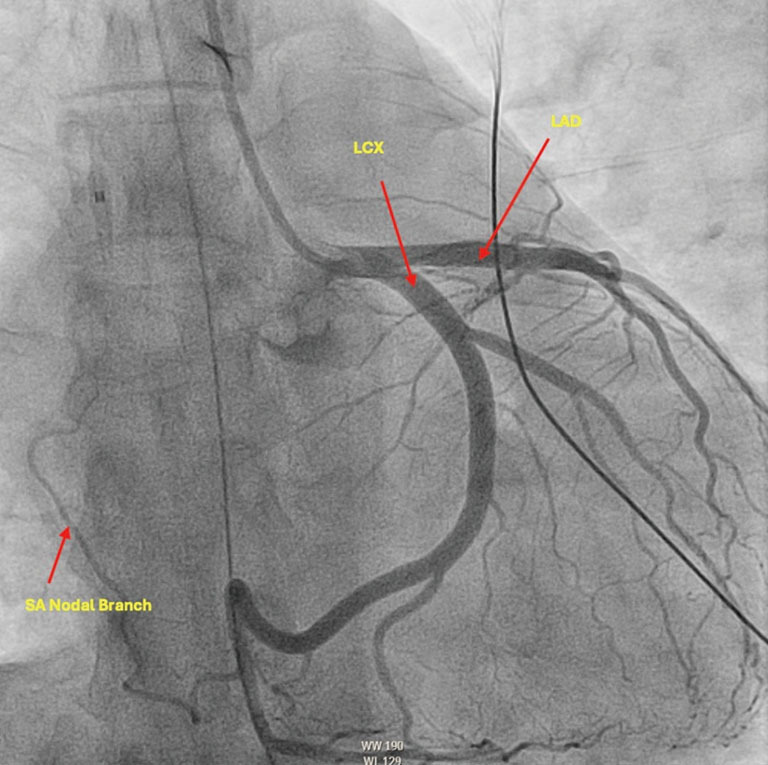 Electrical storm caused by sertraline overdose: case report.