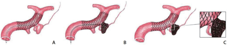 Technical Approaches for Coil Embolization of Unruptured Small Anterior Choroidal Artery Aneurysms: A Focus on Anatomical Flow Preservation of the Anterior Choroidal Artery.