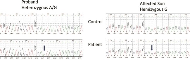 Unusual <i>PHEX</i> variants implicate uncommon genetic mechanisms for X-linked hypophosphatemic rickets.