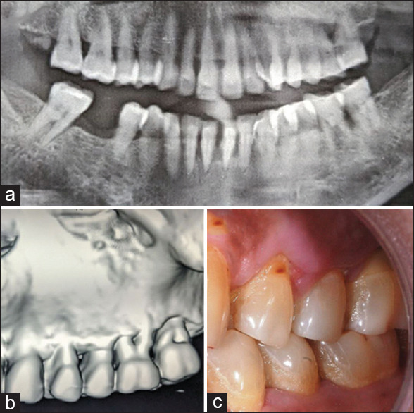 Ultrawide implants for immediate molar extraction socket versus standard diameter fixtures in healed alveolar ridges of missing molars, one-year postloading evaluation: A randomized controlled trial.
