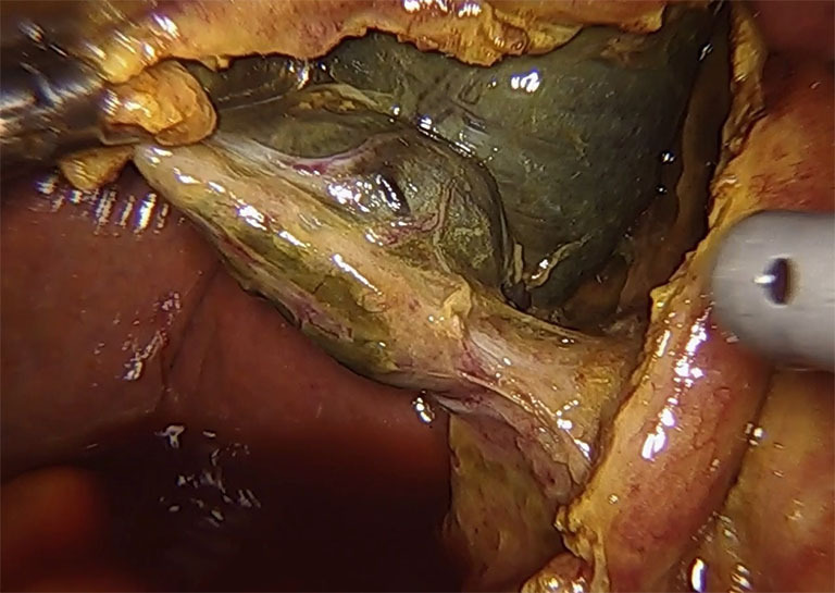 Enhancing the management of acute and gangrenous cholecystitis: a systematic review supported by the TriNetX database.