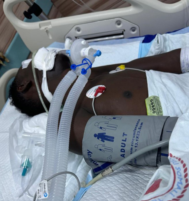 Diagnostic Challenges and Management Strategies for Superior Sagittal Sinus Thrombosis Induced by Snake Bite Envenomation: A Case Report from Somalia.