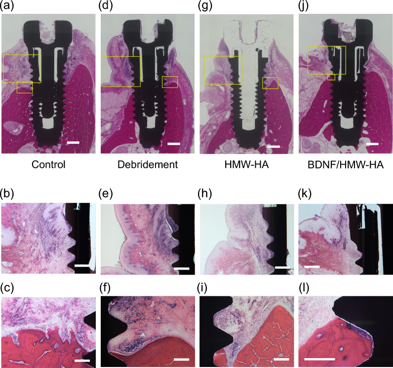 Brain-derived neurotrophic factor promotes bone regeneration in a canine model of peri-implantitis.