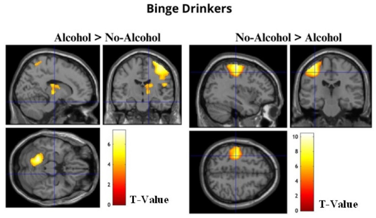 Associative memory in alcohol-related contexts: An fMRI study with young binge drinkers.