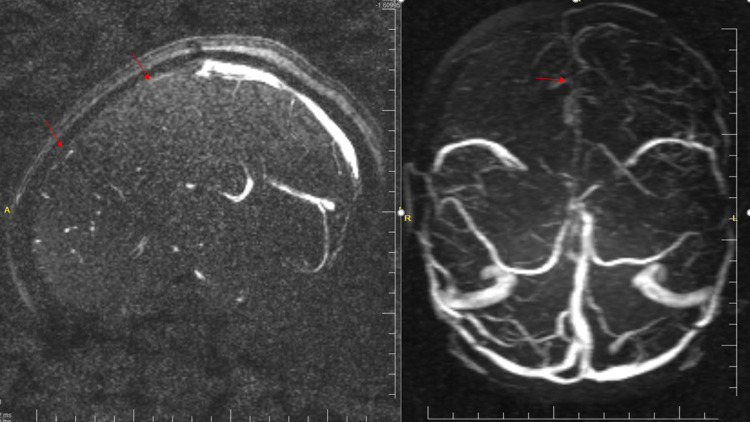 Diagnostic Challenges and Management Strategies for Superior Sagittal Sinus Thrombosis Induced by Snake Bite Envenomation: A Case Report from Somalia.