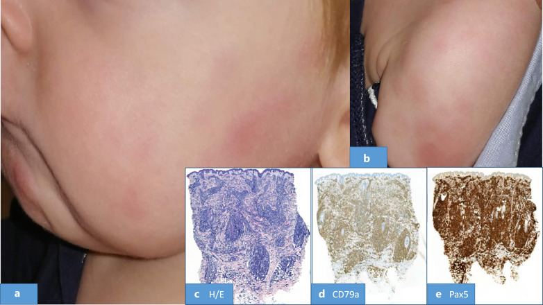 Pediatric Aleukemic Leukemia Cutis with Testicular Involvement: A Case Report.