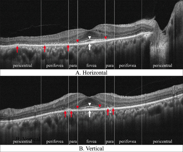 Optical coherence tomography characteristics in hydroxychloroquine retinopathy and the correlations with visual deterioration in Taiwanese.