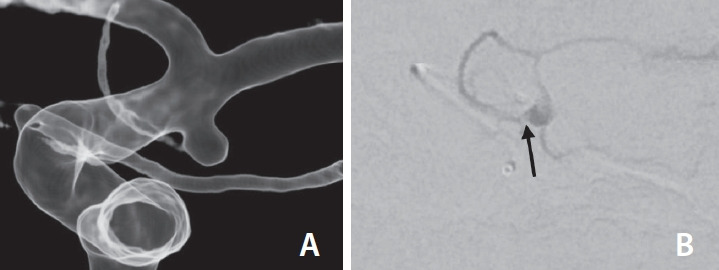 Technical Approaches for Coil Embolization of Unruptured Small Anterior Choroidal Artery Aneurysms: A Focus on Anatomical Flow Preservation of the Anterior Choroidal Artery.