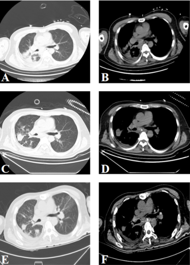 Autoimmune encephalitis with coexisting antibodies to GABABR, GAD65, SOX1 and Ma2.