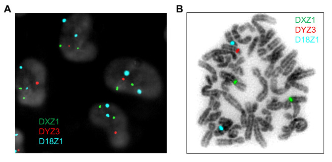 False-positive XXY results by interphase FISH in cytogenetically normal XX individuals: two cases highlighting the necessity of additional laboratory follow-up.