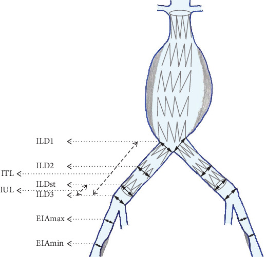 The Long-Term Progression of Aneurysmal Disease in Common Iliac Arteries After Standard EVAR and Its Clinical Implications.