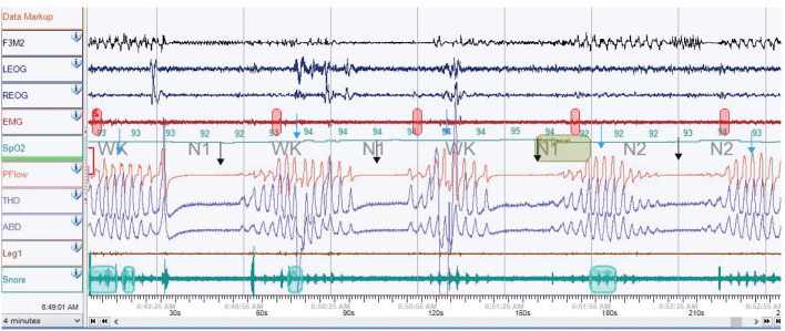 Management of central sleep apnoea: a review of non-hypercapnic causes.