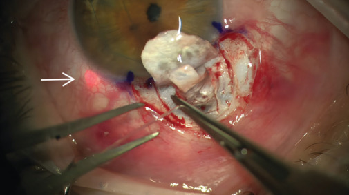 Outcomes of microcatheter-assisted trabeculotomy in adult patients with primary congenital glaucoma and juvenile open-angle glaucoma: A case series.