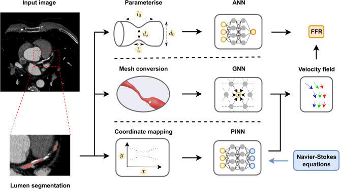 The role of artificial intelligence in coronary CT angiography.