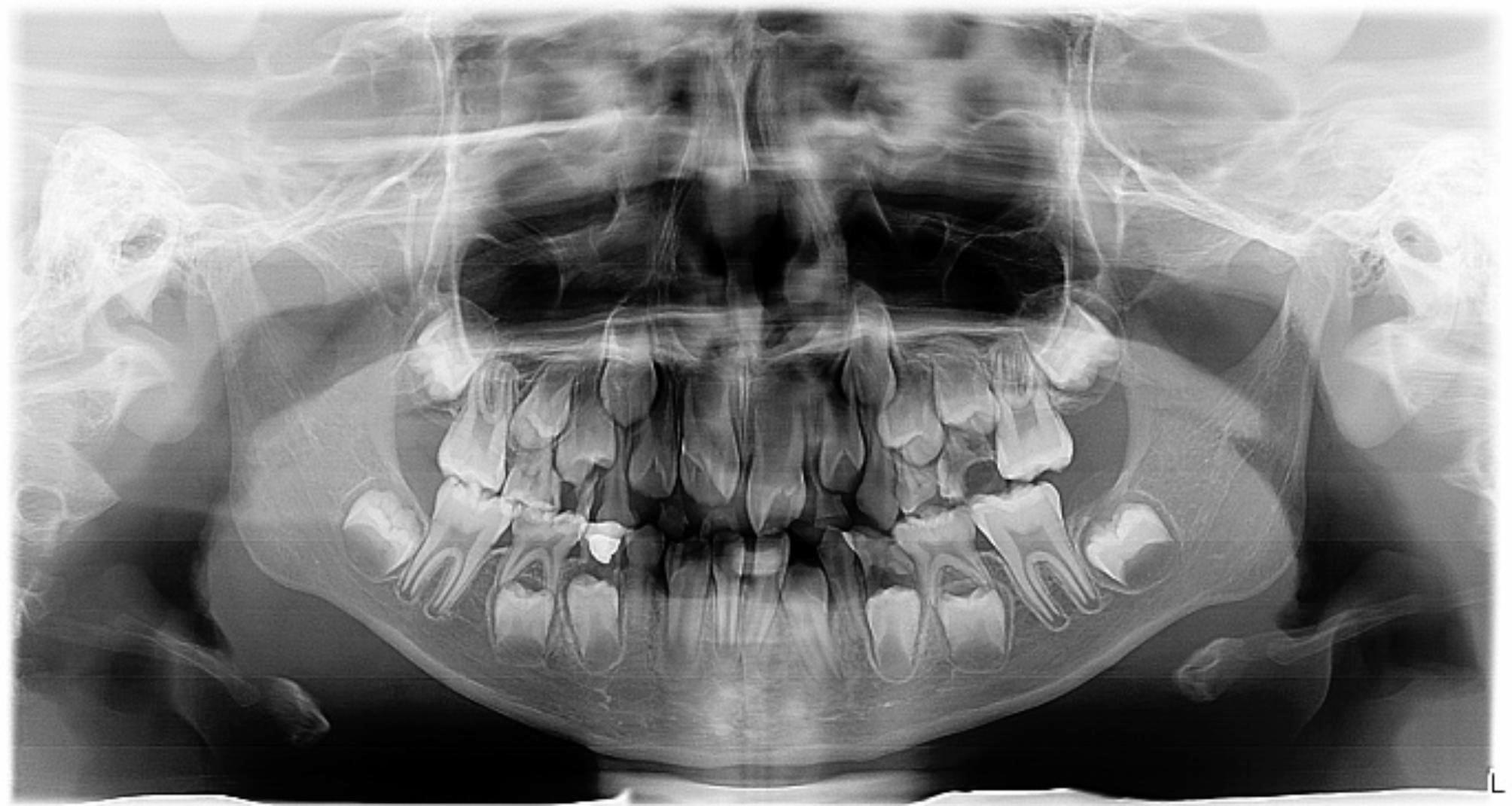 Congenitally missing permanent canines in a sample of Chinese population: a retrospective study.
